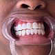 Veneer removal
