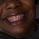 Top & Bottom Braces