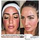 SQT Biomicroneedling when buying bundle