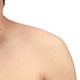 SKIN TAG REMOVAL