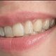 Toothgems