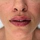 Lip Filler