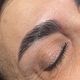 Brow Lift 