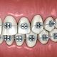 Traditional Braces