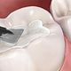 Sealants Application