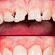 Composite Filling