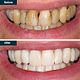Professional Deep Teeth Cleaning