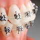 Self-ligating Braces