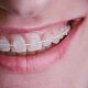 Ceramic Braces