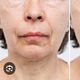 Ultherapy