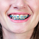 Dental Braces Consultation and Down Payment *Options A - D
