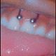 Smiley piercing