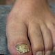 Medical  pedicure